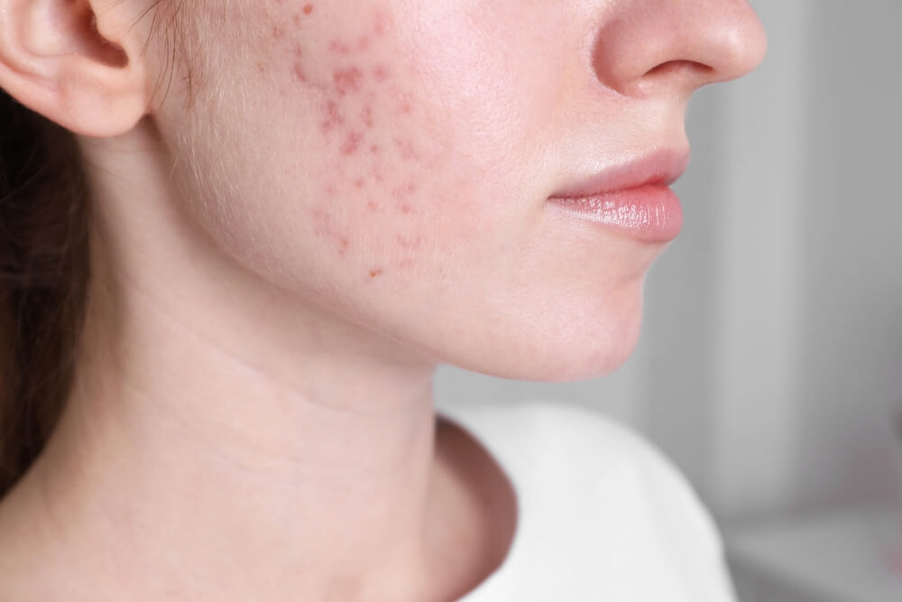 woman acne scars