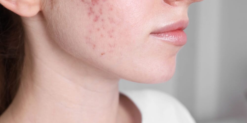 woman acne scars